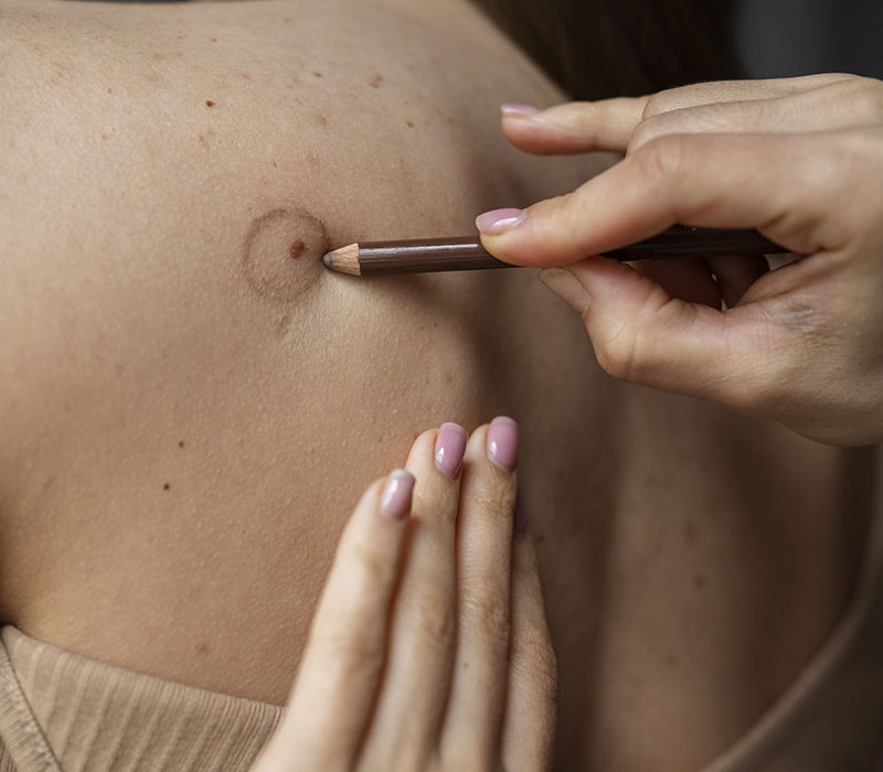 scar-treatment-img1